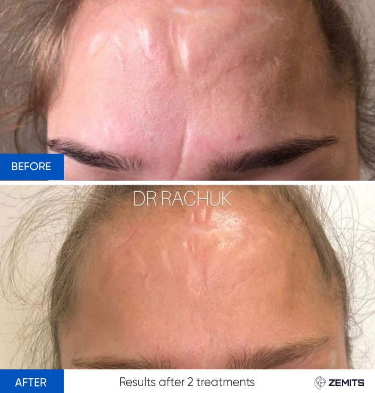 Zemits CarbonFrax Pro: Κλασματικό Λέιζερ CO2