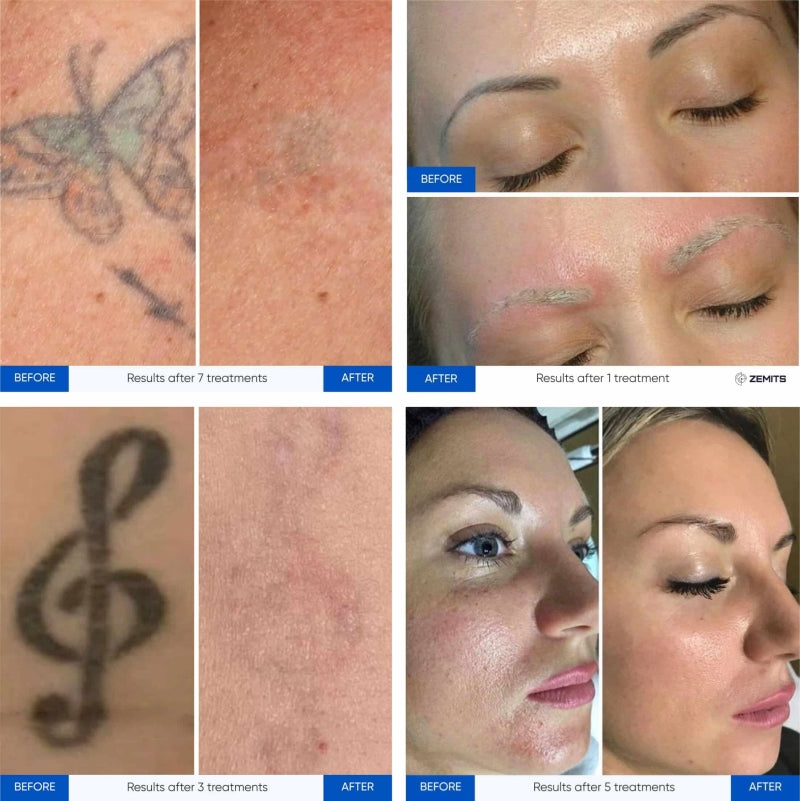 Zemits YAGenix Q-Switched Nd:YAG Λέιζερ