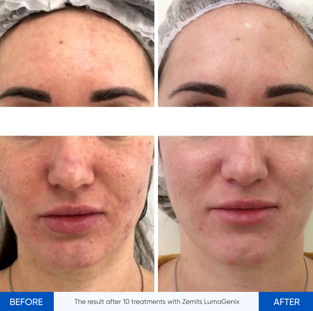 Zemits LumaGenix PDT Επαγγελματική Συσκευή Φωτοθεραπείας LED