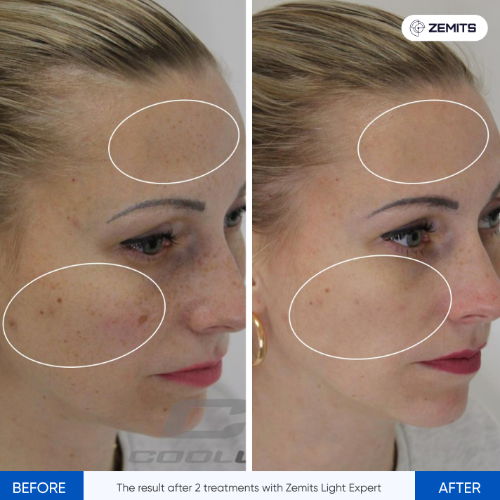 Zemits Light Expert 2.0 Μηχάνημα IPL Λέιζερ