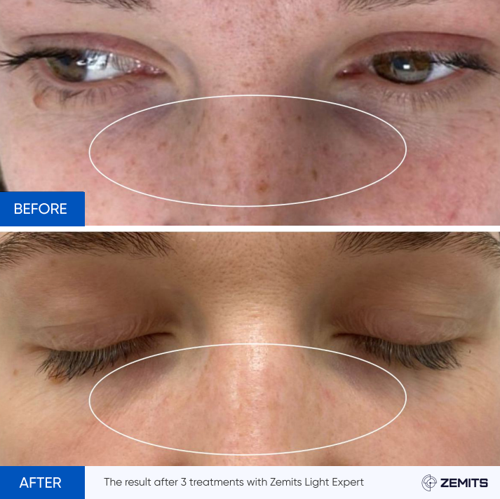 Zemits Light Expert 2.0 Μηχάνημα IPL Λέιζερ