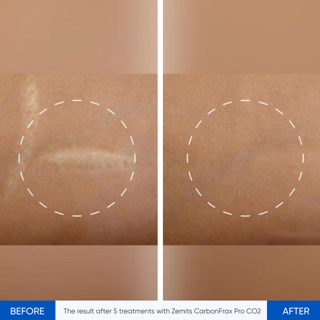 Zemits CarbonFrax Pro: Κλασματικό Λέιζερ CO2