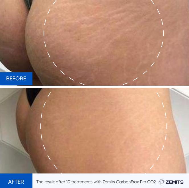 Zemits CarbonFrax Pro: Κλασματικό Λέιζερ CO2