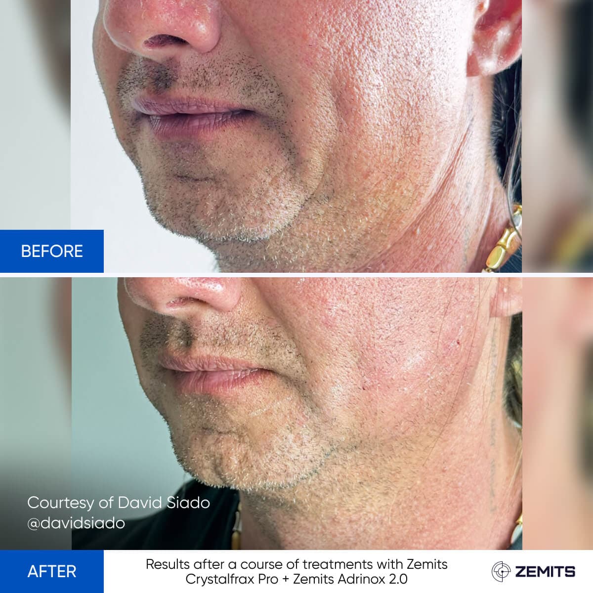 Before After Slide 17