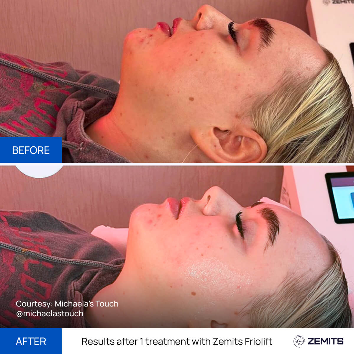 Before After Slide 1