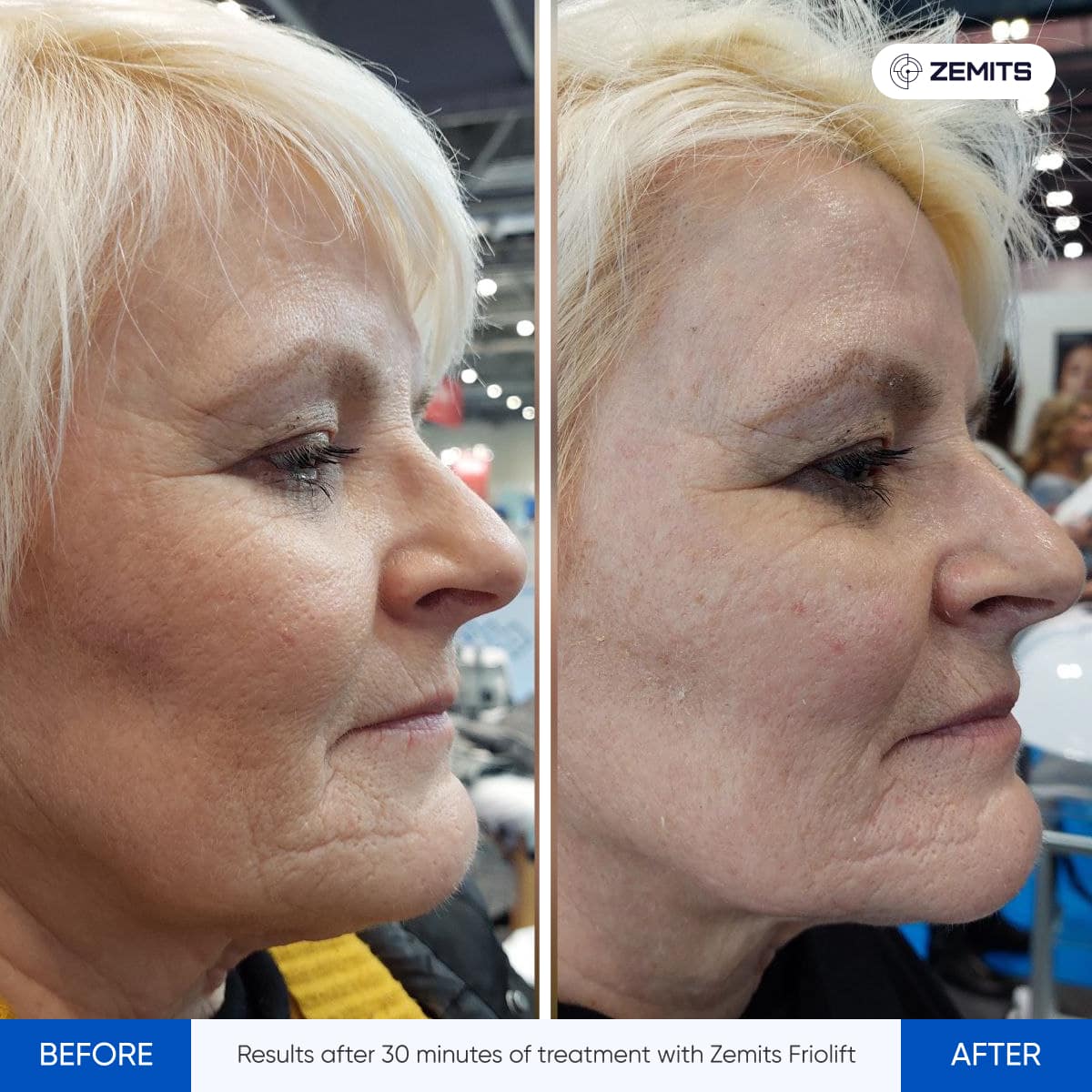 Before After Slide 17