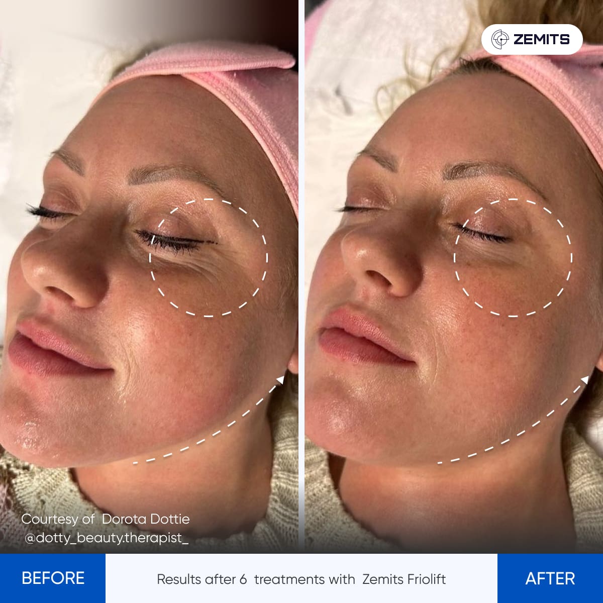 Before After Slide 19