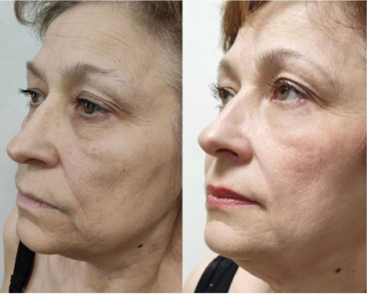 Zemits LumaGenix PDT Επαγγελματική Συσκευή Φωτοθεραπείας LED