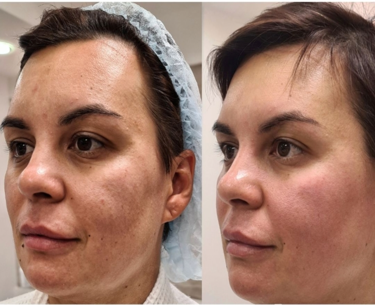 Zemits LumaGenix PDT Επαγγελματική Συσκευή Φωτοθεραπείας LED