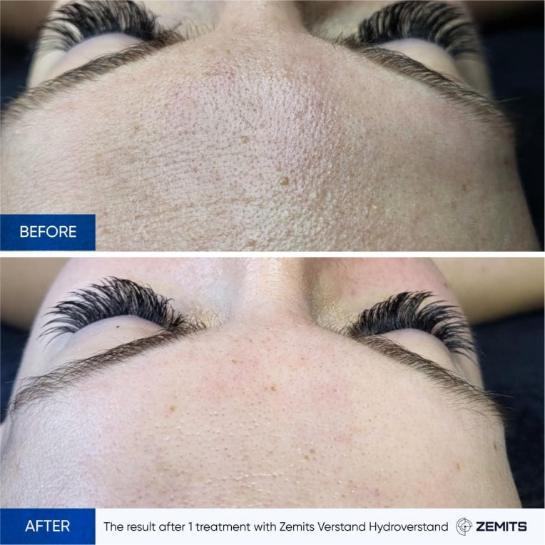 Zemits HydroVerstand PRO 7-σε-1 Σύστημα HydroDiamond™