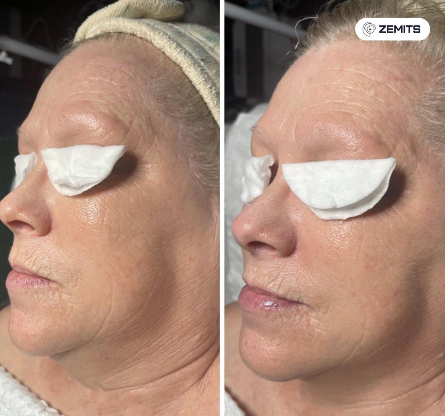 Zemits Klein EL Σύστημα Ηλεκτροπόρωσης