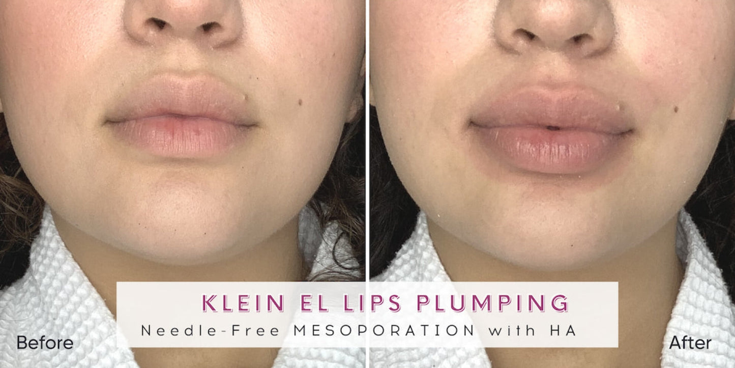 Zemits Klein EL Σύστημα Ηλεκτροπόρωσης