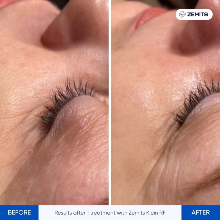 Zemits Klein RF Σύστημα Σύσφιξης Δέρματος