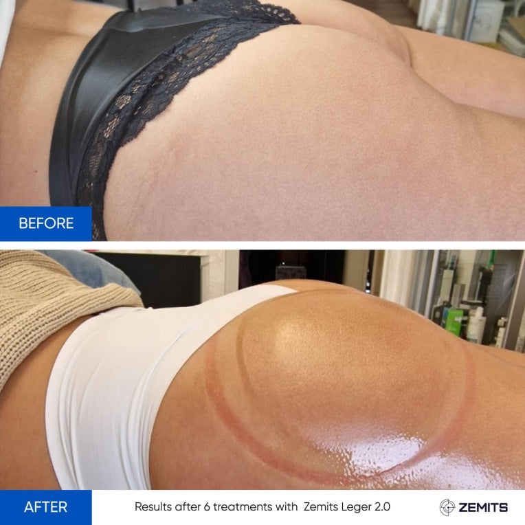 Zemits Leger 2.0 Σύστημα Κενού με Κύπελλα XXL σε Σετ