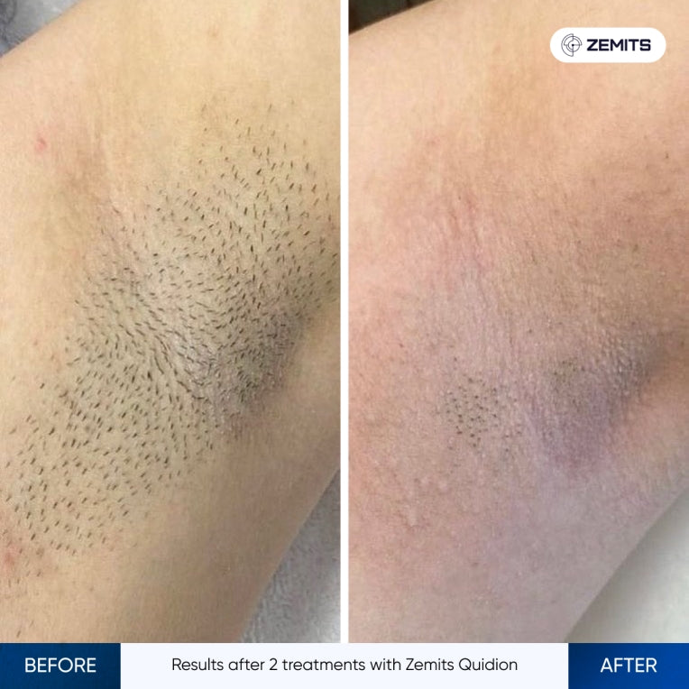Zemits Quidion Διοδικό Λέιζερ Για Αποτρίχωση