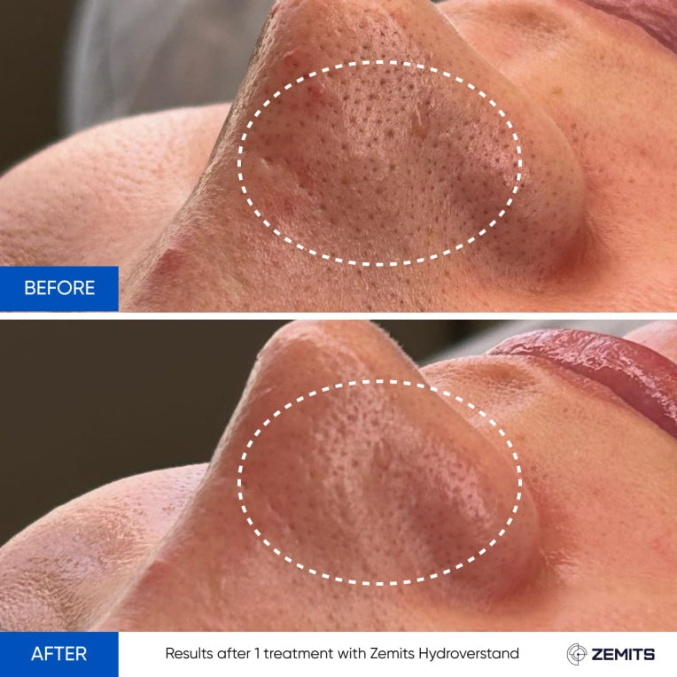 Zemits HydroVerstand PRO 7-σε-1 Σύστημα HydroDiamond™