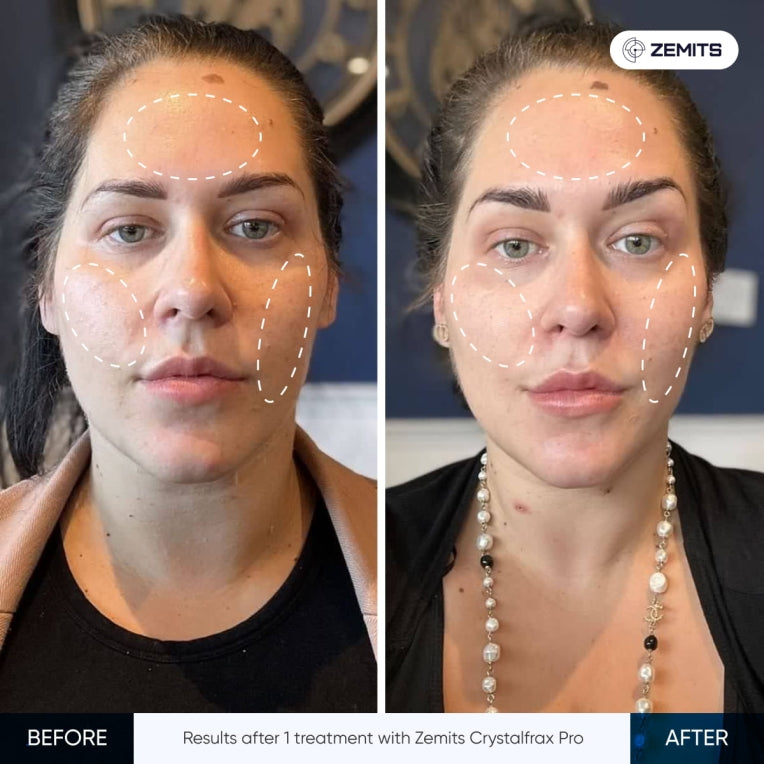 Zemits CrystalFrax PRO Μη Επεμβατικό Κλασματικό Σύστημα RF