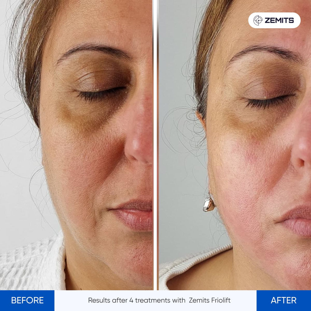 Before and after RF cryo treatment results Zemits FrioLift