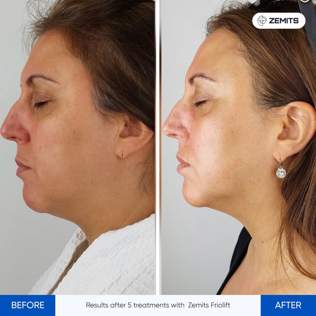Before and after RF cryo treatment results Zemits FrioLift